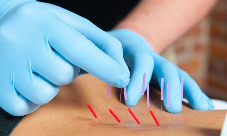 Dry Needling Carrollton